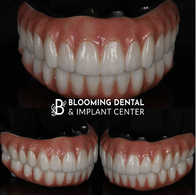 Hybrid Implant Bridge
