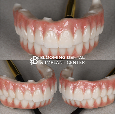 Zirconia Implant Bridge