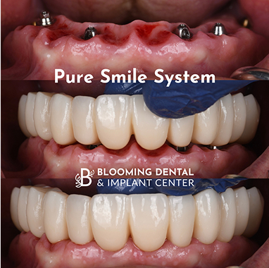 Porcelain Implant Bridge